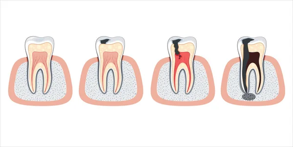 Ilustración Dental Dañada Dientes Dañados Ilustración Vectorial Del Dentista Cuidado — Vector de stock