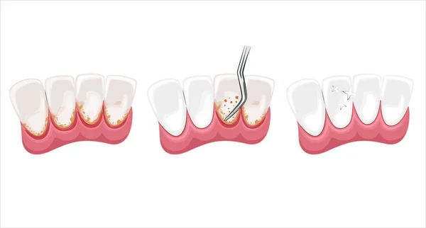 Limpieza Dental Ilustración Dientes Saludables Vector Dentista Ilustración Cuidado Oral — Vector de stock