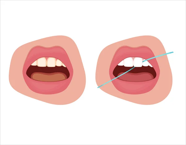 Ilustración Agujas Dentales Dientes Sanos Ilustración Vectores Dentistas Cuidado Bucal — Vector de stock