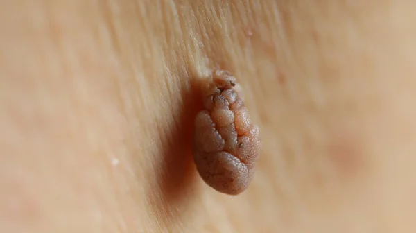 閉じる 皮膚のタグまたは皮膚に接続され 小さな茎やペダウンクルからぶら下がっている多孔質の成長 ストック画像