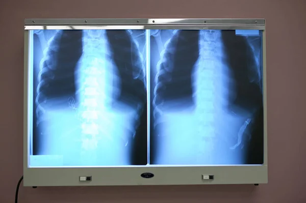 환자의 골절이나 질병을 병원의 상자에 엑스레이 스톡 사진