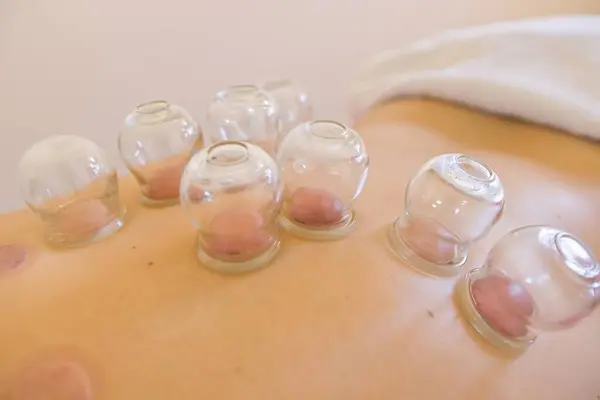 Traditional Chinese Cupping Therapy on the Back by Naturopath. Chinese Cup. Naturotherapy, massages, alternative medicine, natural medicine.