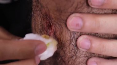 Kafa derisindeki yarayı antiseptik solüsyonla tedavi eden birine yakın durmak, yaralanmadan sonra hijyen ve tıbbi tedavinin önemini gösterir..