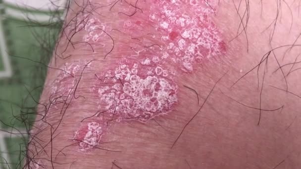 アジアの膝の上の乾癬 ベトナム — ストック動画
