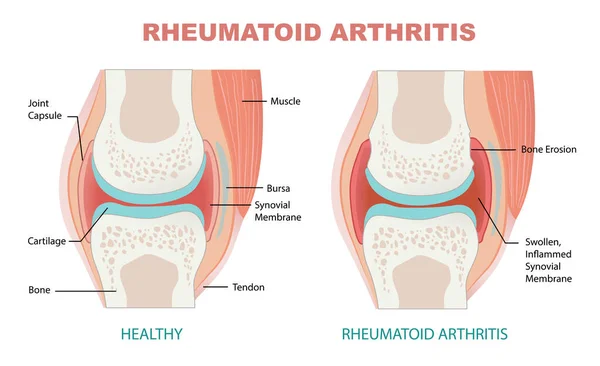 Jämförelse Mellan Friska Gemensamma Och Reumatoid Artrit Illustration — Stock vektor