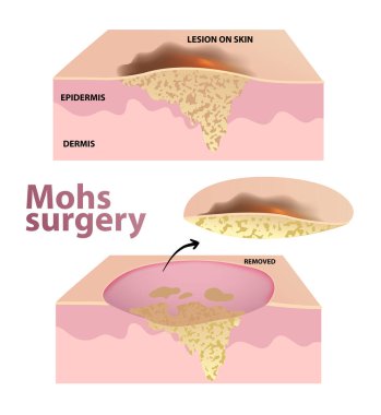 Mohs Cerrahisinin İllüstrasyonu