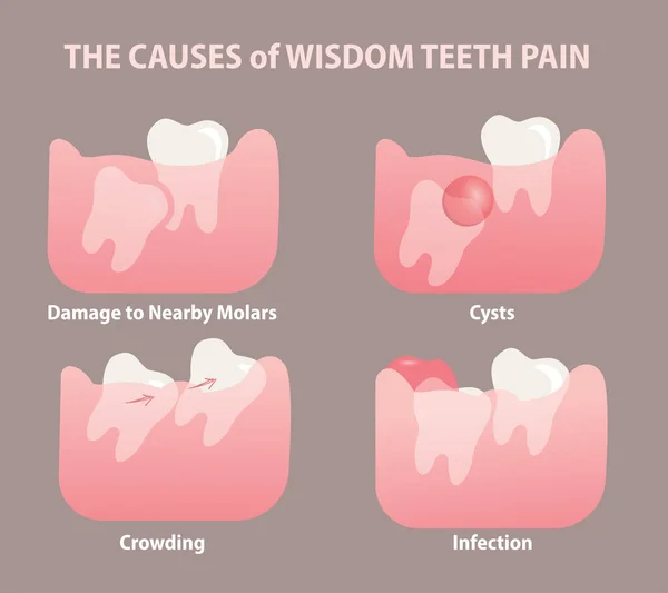 Causes Wisdom Tooth Pain Illustration — Stock Vector