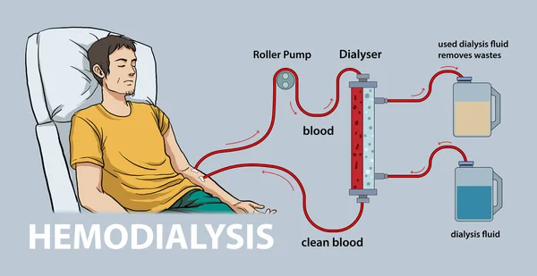 stock vector illustration of hemodialysis diagram