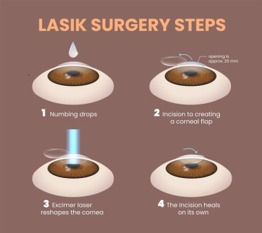 illustration of lasik eye surgery steps clipart