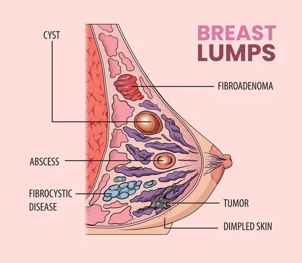 妇女乳房肿块类型的说明 — 图库矢量图片