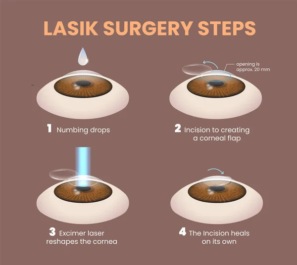 Illustration Lasik Eye Surgery Steps — Stock Vector