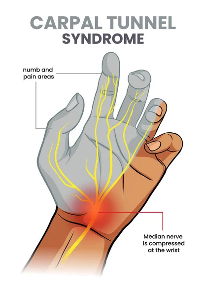 手の感覚野を持つカルパルトンネル症候群の図です — ストックベクタ