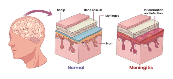 脑膜炎的例子 覆盖大脑的炎症膜 — 图库矢量图片