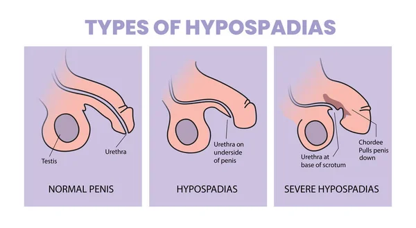 Types Hypospadias Illustration — Stock Vector