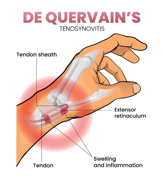 Illustration Quervain Syndrom — Stock vektor