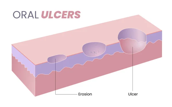 Illustration Oral Ulcer Diagram — Stock Vector