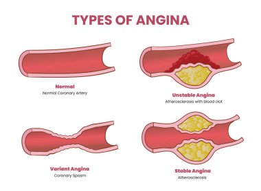 types of angina illustration clipart