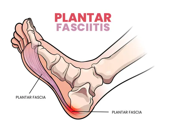Plantar fasiit diyagramının gösterimi