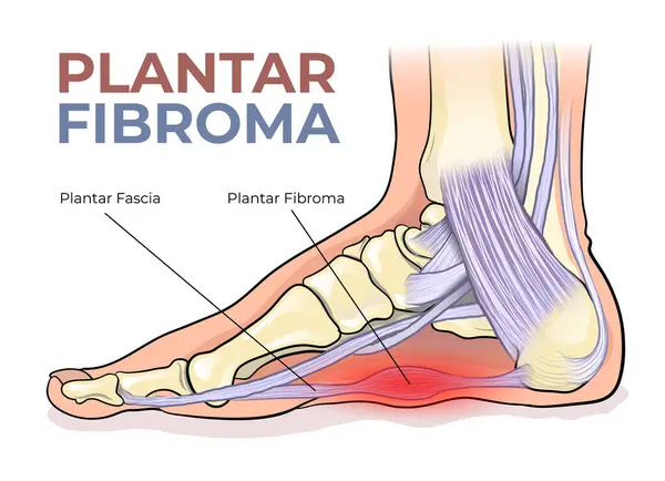 Plantar fibroma diyagramının gösterimi