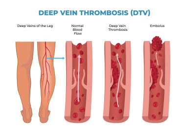 Derin ven trombozu diyagramı, DVT