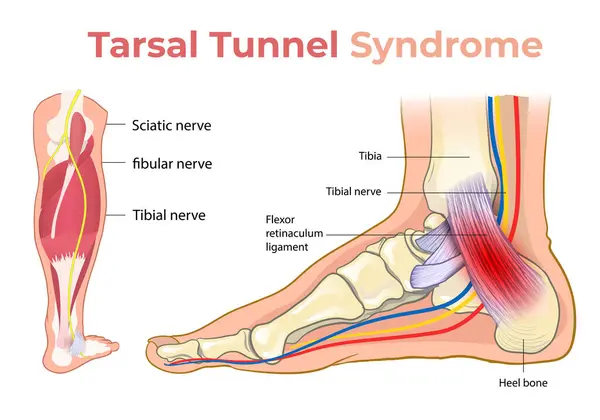 Tarsal tünel sendromu diyagramının çizimi