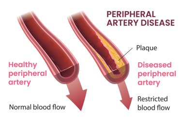 Periferik arter hastalığının gösterimi