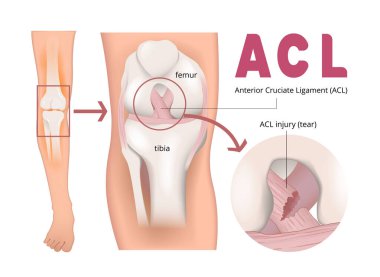 ACL yaralanma İnfografiğinin gösterimi