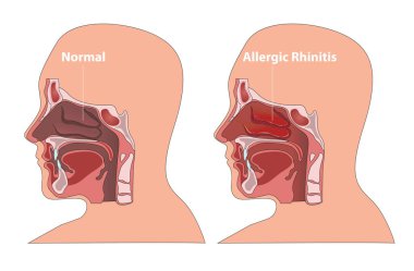 Sağlıklı burun geçişi ile rhinitis alerjisi arasındaki illüstrasyon.