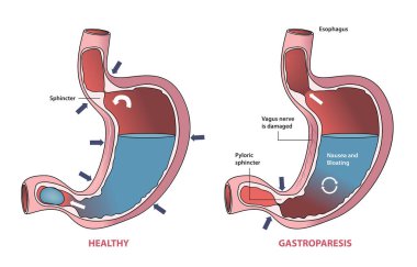 Sağlıklı mide ve gastroparezi durumu.