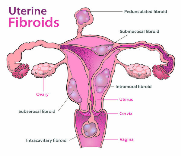 Illustration of the Uterine fibroids in Female reproductive organ