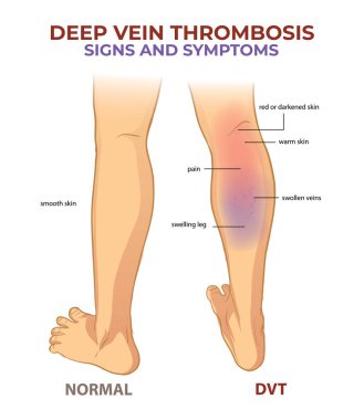 DVT işaretleri ve belirtiler