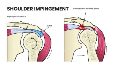 Omuz çarpması diyagramının gösterimi