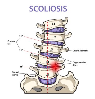 Scoliosis yapı diyagramının gösterimi