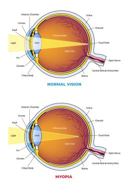 Myopia, normal göz diyagramına karşı.