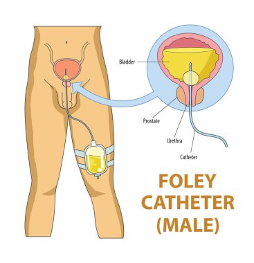 Erkek diyagramında foley kateteri çizimi