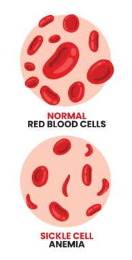 Normal kırmızı kan hücrelerine karşı anemi.
