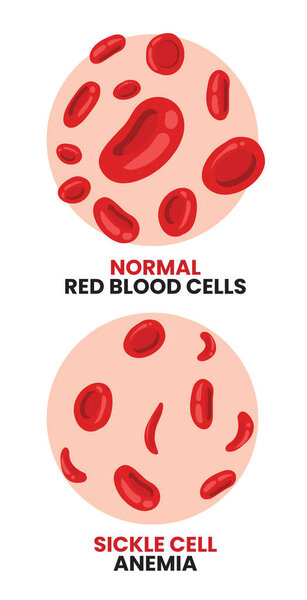 иллюстрация нормальных эритроцитов против анемии