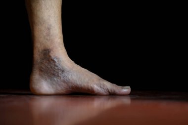 Kişinin ayağında deri solgunluğunun ve varis damarlarının etkilerini gösteren ayrıntılı görüntü, eğitim, tıbbi ve tartışma amaçlarına yardımcı olmak için durumun etkisini ve görsel özelliklerini vurguluyor.