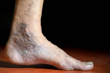 Kişinin ayağında deri solgunluğunun ve varis damarlarının etkilerini gösteren ayrıntılı görüntü, eğitim, tıbbi ve tartışma amaçlarına yardımcı olmak için durumun etkisini ve görsel özelliklerini vurguluyor.