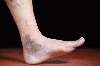 Kişinin ayağında deri solgunluğunun ve varis damarlarının etkilerini gösteren ayrıntılı görüntü, eğitim, tıbbi ve tartışma amaçlarına yardımcı olmak için durumun etkisini ve görsel özelliklerini vurguluyor.