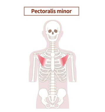 Pectoralis minör kas anatomisinin yansıması. 