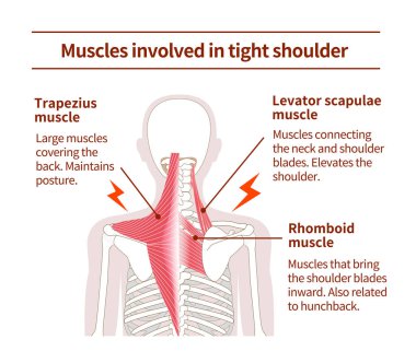 Muscle sets in the back that cause tight shoulder clipart