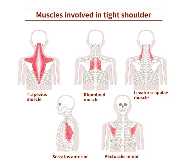 背中の筋肉のセットは タイトな肩を引き起こす — ストックベクタ