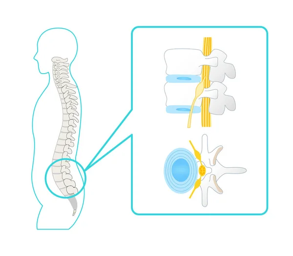 健康な腰椎のイラスト Vertebrae Sciatic Neru — ストックベクタ
