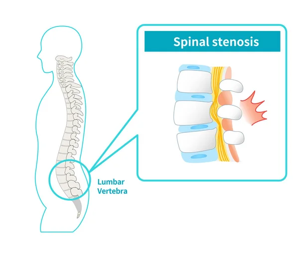 stock vector Illustration of lumbar spinal canal stenosis