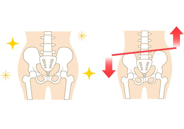 左右傾いた骨盤と姿勢 — ストックベクタ