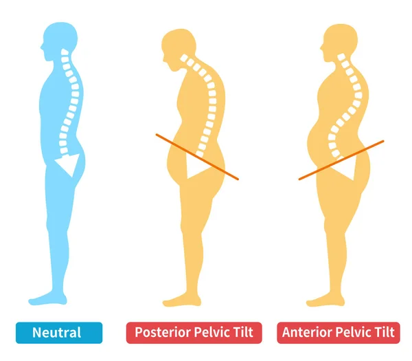 Pelvic Forward Backward Tilt Correct Posture Body Illustration — Stock Vector