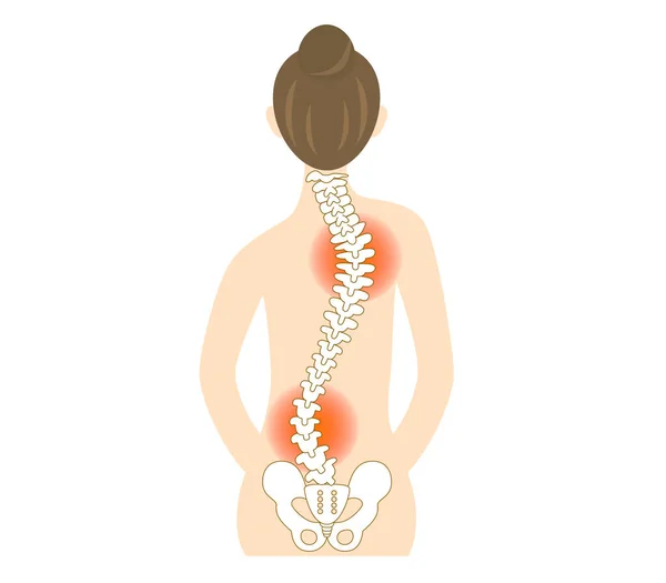 Illustration Back Woman Scoliosis Bent Spine — Stock Vector