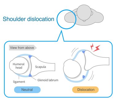 Yukarıdan omuz ekleminin mekanizması ve nedenleri
