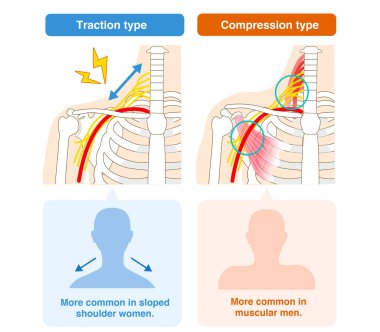Two types of thoracic outlet syndrome, traction and compression clipart